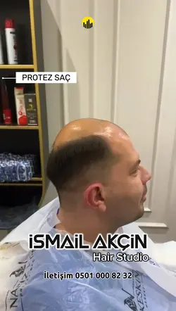 Protez saç