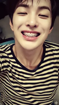 braces trend