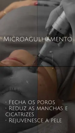 Microagulhamento