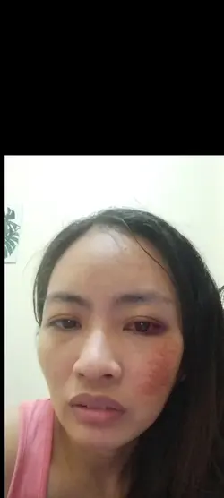 Hurt filter