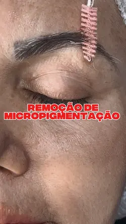 Remoção de micro