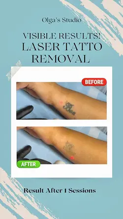 Laser Tattoo Removal