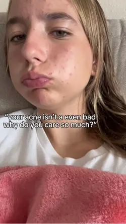 I hate my acne