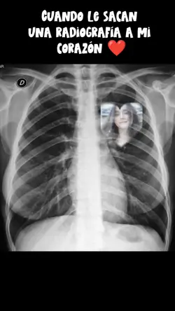 Radiografía Corazón 