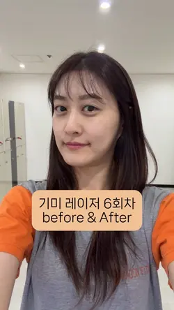 기미 레이저 6회차 비포 에프터