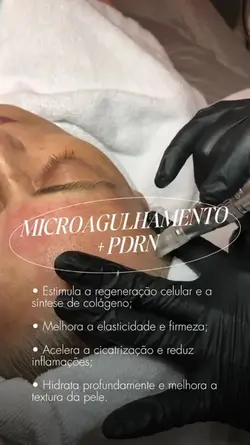 Microagulhamento