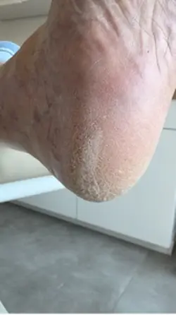 pedicure 