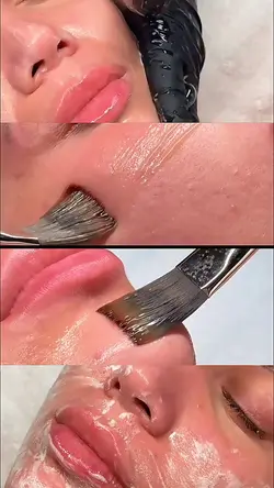 Microneedling aesthe