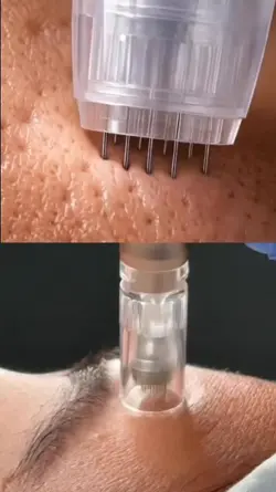 microagulhamento 