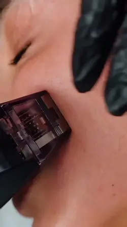 Microneedling aesthe