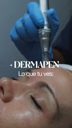 Dermapen PRP