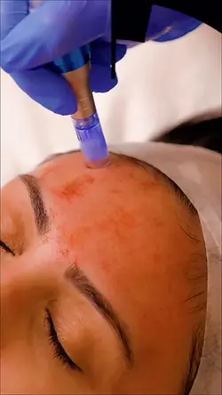 Microneedling aesthe