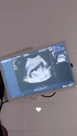 Ultrasound baby