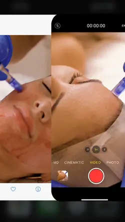 Microneedling