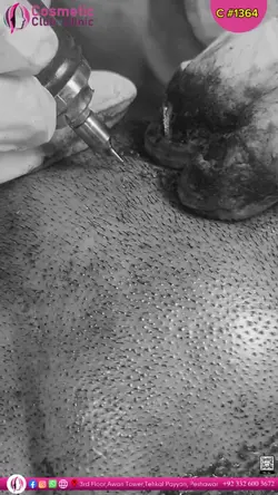Hair Transplant Ccc