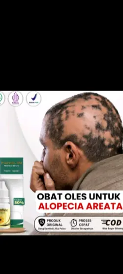 alopecia
