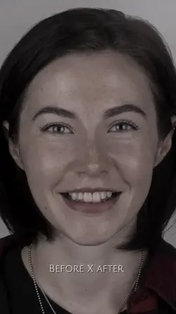 Antes Depois Facetas