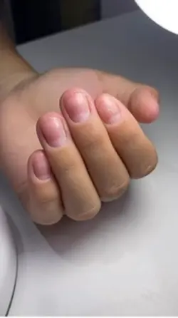 Before After Nail