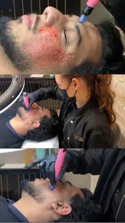 microagulhamento