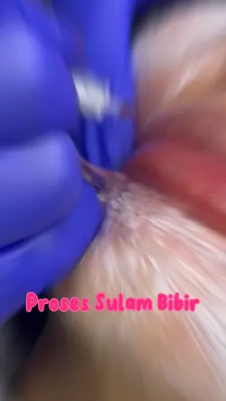 Treatment Bibir