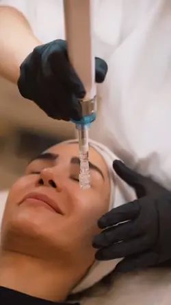 Microneedling aesthe