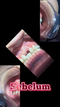 Dental template