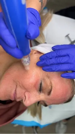 Needling 