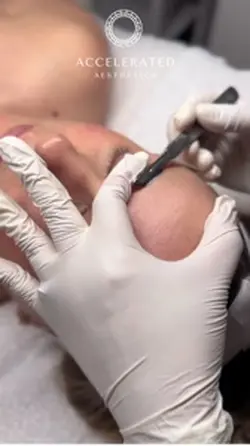 Dermaplaning 