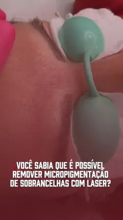 Remoção a laser