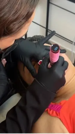 Micro Labial Estétic