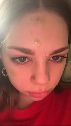 acne+bloatin