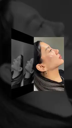 Botox treatment