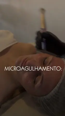 Microagulhamento