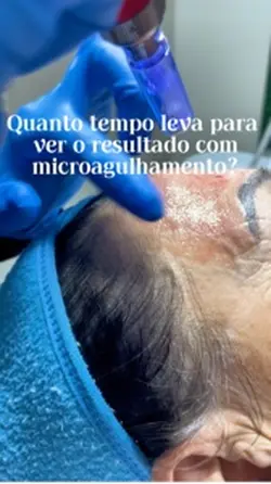 Microagulhamento