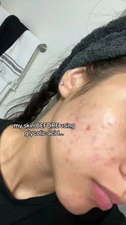 Before&after my skin