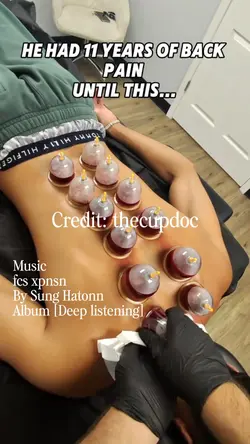Cupping