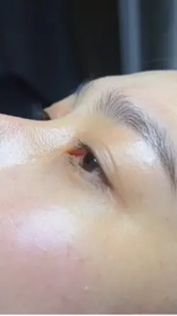 Biến hình uốn mi 