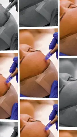 Microneedling