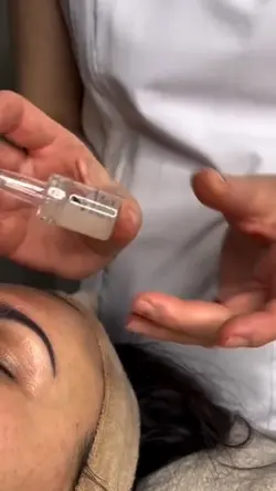 Microneedling