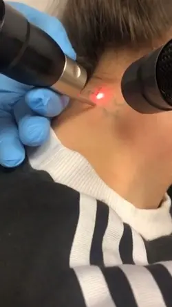Laser Tattoo Remova