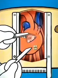 Open Heart Surgery